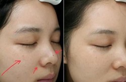 激光皮肤美白效果怎样？有没有副作用？