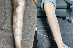 皮肤美白方法哪种最有效？有没有副作用？