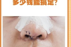 鼻翼下垂可以不做手术吗？有哪些方法？