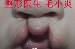 兔唇可以彻底治好吗？治疗方法有哪些？