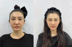 法令纹手术怎么做，恢复期要多久？