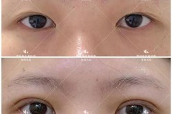 杭州割双眼皮哪家医院技术好？求推荐！