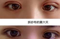 双眼皮手术费用一般多少？包括哪些服务？
