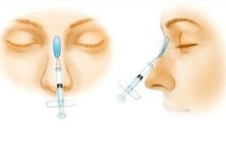 玻尿酸隆鼻副作用大吗？如何避免？