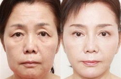 手术去皱纹效果好吗？恢复期需要多久？