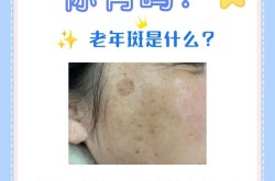 老年斑怎么回事？如何预防和治疗老年斑？