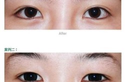 韩式翘睫毛手术安全吗？需要注意什么？