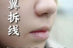 鼻骨缩小手术风险大吗？术后需要注意什么？