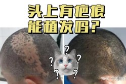 广州植发价格贵吗？植发手术成功率多高？