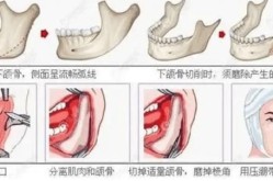 下颌角切除费用是多少？手术风险大吗？