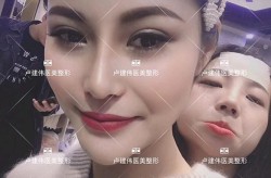 喜悦整形做鼻子好吗？价格大概是多少？
