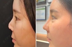 鼻尖矫正手术复杂吗？效果自然吗？
