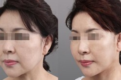 逸美玻尿酸好不好？效果和使用感受评价！