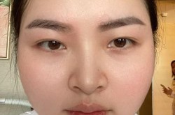 哪家医院去除纹眉效果好？有没有什么副作用？