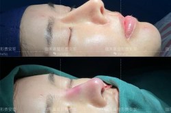 鼻子整容费用咨询：如何选择适合自己的鼻整形？