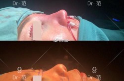 膨体隆鼻缺点是什么？有没有更好的替代方案？