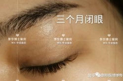 变双眼皮手术安全吗？恢复期需要多久？