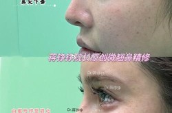 玻尿酸隆鼻价位一般是多少？玻尿酸隆鼻有哪些优势？