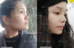 耳软骨垫鼻尖手术风险大吗？效果能维持多久？