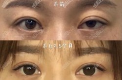 哪个割双眼皮手术做的最好？如何选择医院？