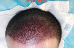 植发哪里最靠谱？求推荐技术和口碑好的医院！