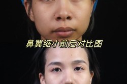 鼻翼缺损整形手术怎么做？效果能维持多久？