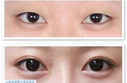 医院割双眼皮多少钱？哪种方法最好？