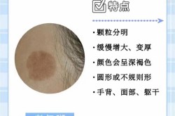 老年斑的形成原因是什么？有哪些方法可以去除？