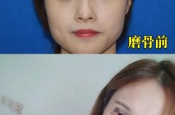 磨骨手术费用是多少？有没有后遗症？