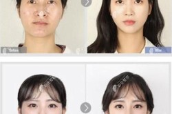 郑柔美整容前后对比照曝光，整形手术风险大吗？