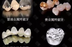 钴铬合金烤瓷牙价格贵吗？使用寿命多久？