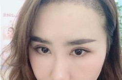 毛发植发一次种多少根？植发手术的效果能维持多久？