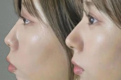 怎样去除咬肌？有没有快速有效的方法？