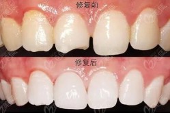 美容冠矫正牙齿效果如何？矫正过程需要注意什么？