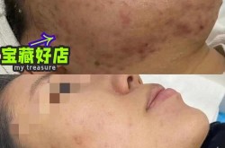 莱钢医院整形科治疗痘痘效果如何？有没有案例？