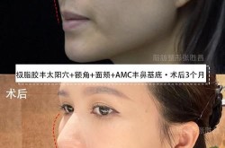 丰太阳穴有哪些好处？手术风险大吗？