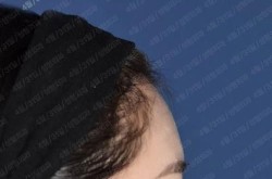 额头可以整形吗？有哪些手术方法和风险？