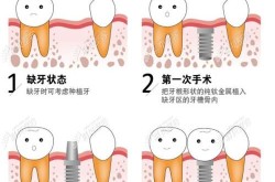 种植牙哪里好？如何判断种植牙的成功率？