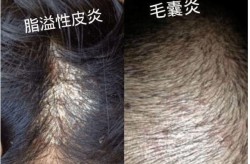 种头发危害大吗？如何避免术后并发症？