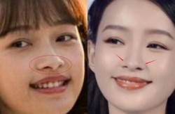 美模整形整容前后对比照曝光，变化大吗？