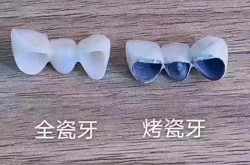 烤瓷牙的使用寿命有多长？有哪些优缺点？