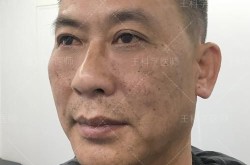 副乳手术风险大吗？如何避免手术后的并发症？