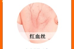 去红血丝的有效方法有哪些？如何防止反复？