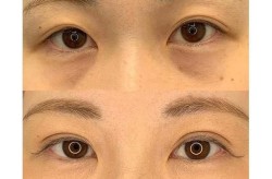 手术去除眼袋后会不会反弹？费用大概是多少？
