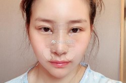 北京隆鼻手术哪里做得好？需要注意什么？
