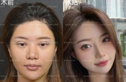玻尿酸隆鼻前后对比照片真实吗？效果持久吗？