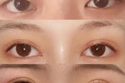 和平整形医院做双眼皮怎么样？价格贵吗？
