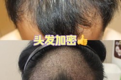 种头发去哪里好？国内哪些医院技术强？