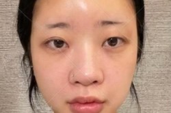鼻孔整形手术风险大吗？