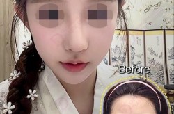 v-line整形手术适合什么样的人群？有哪些优缺点？